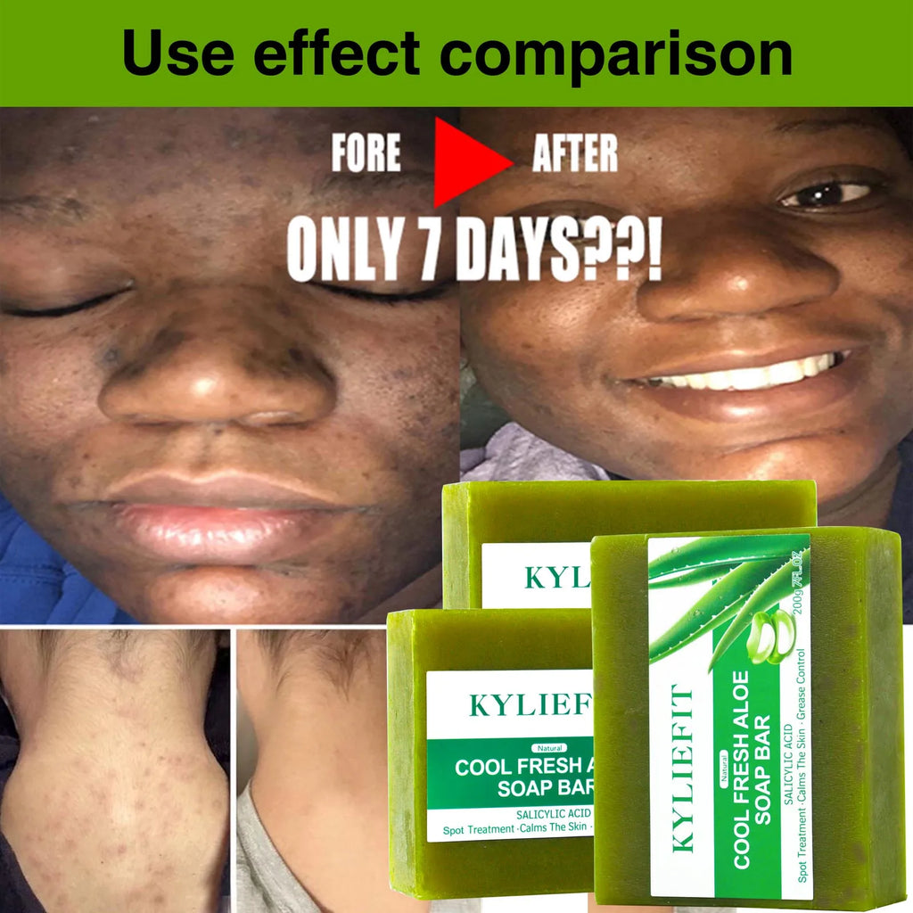Aloe Brightening Soap Bar, Remove Dark Spots, Sun Spots, Acne, Oil Control, Clean Stains, Exfoliation, For Face and Body, 200g